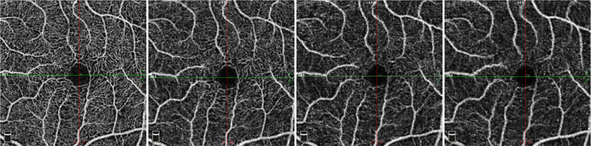 Importance of Focus in OCT Angiography